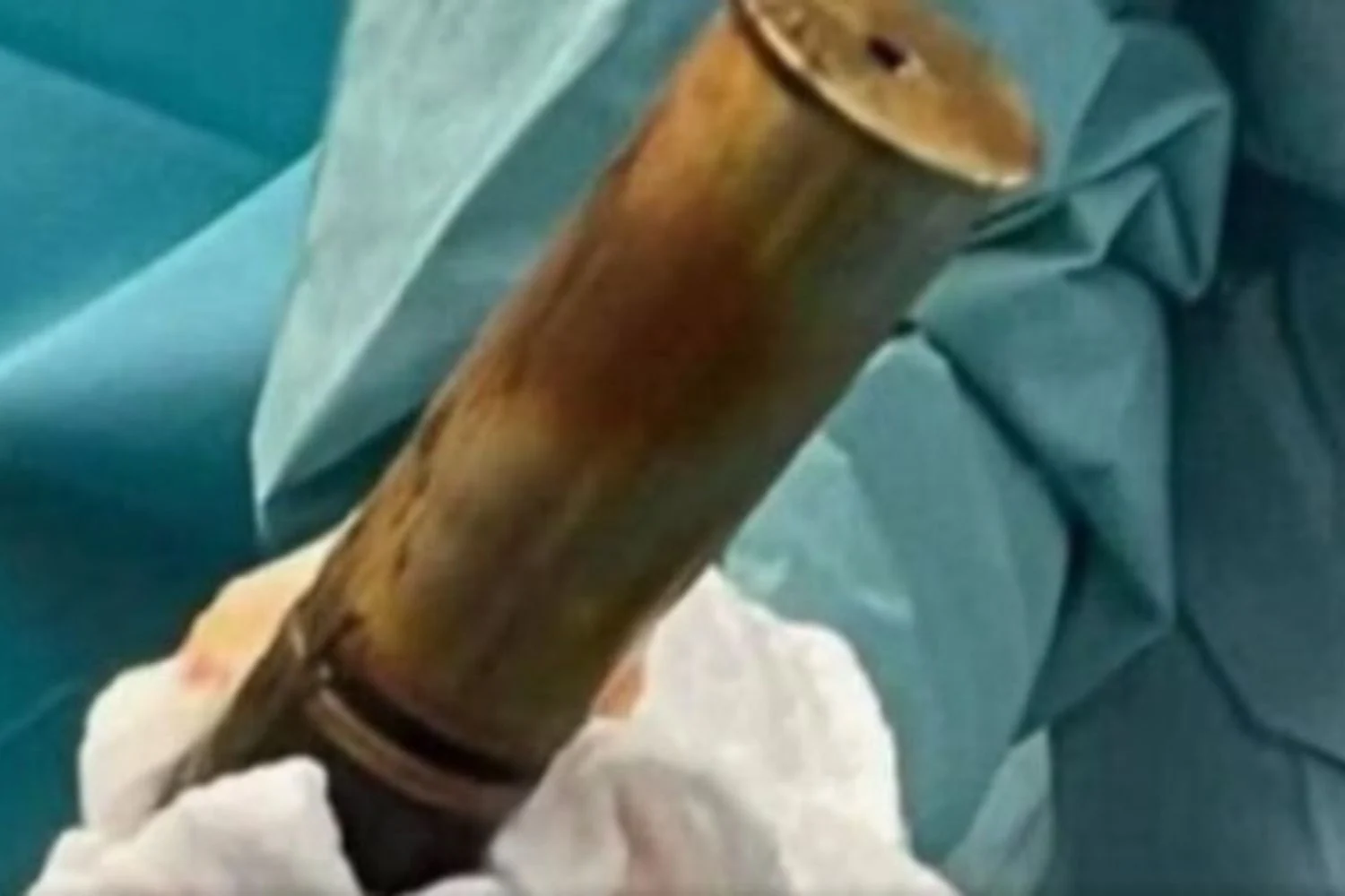 Paciente chega a hospital de Toulouse com projétil da Primeira Guerra alojado no reto; desarmadores neutralizam ordigno