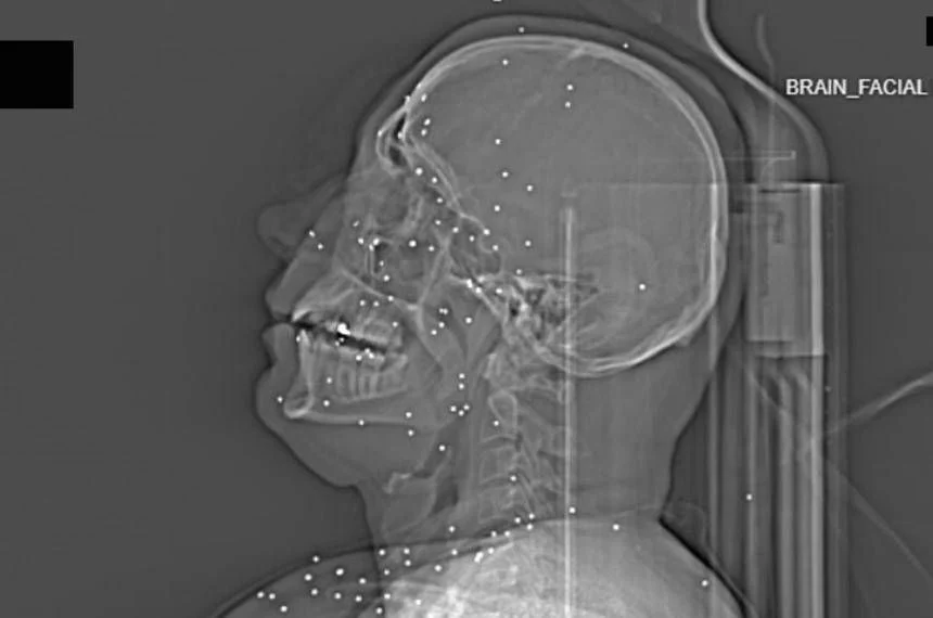 Radiografias expõem padrão letal na repressão iraniana: tiros a olhos, tórax e genitais