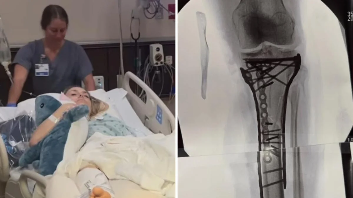 Lindsey Vonn, quinto intervento negli Usa e foto delle ecografie: «Oltre sei ore, ci sono volute tante placche e viti. Non è ancora finita» — corriere.it