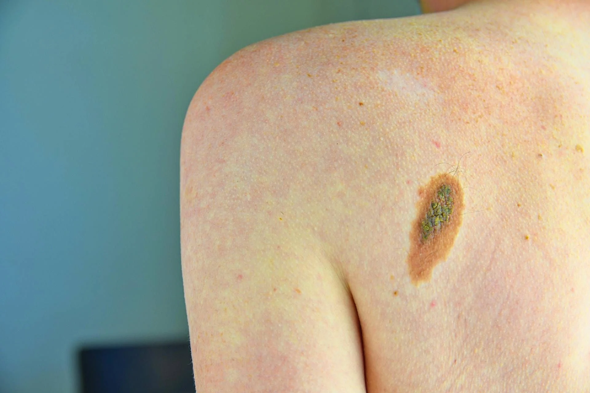 Imunoterapia revoluciona prognóstico do melanoma: metade dos casos avançados ganha nova esperança