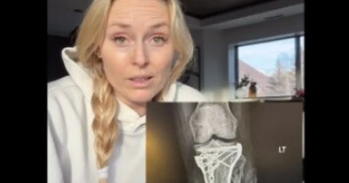 Lindsey Vonn revela risco de amputação após queda em Milano-Cortina: 'Dr. Tom Hackett salvou minha perna'