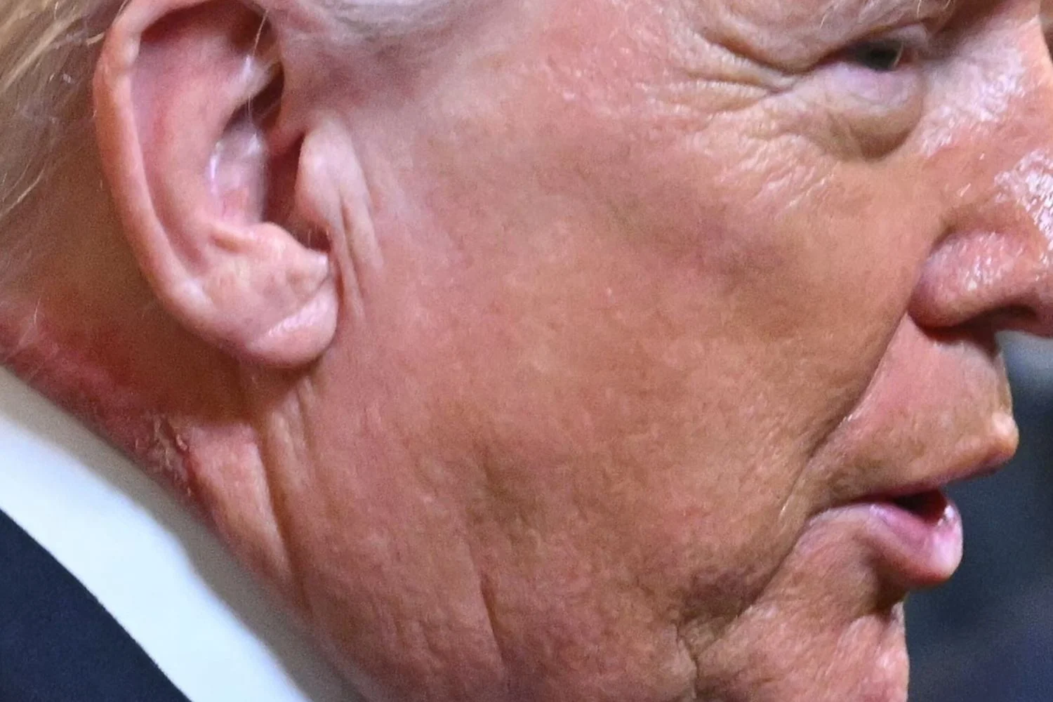 Trump com mancha vermelha no pescoço reacende dúvidas sobre sua saúde