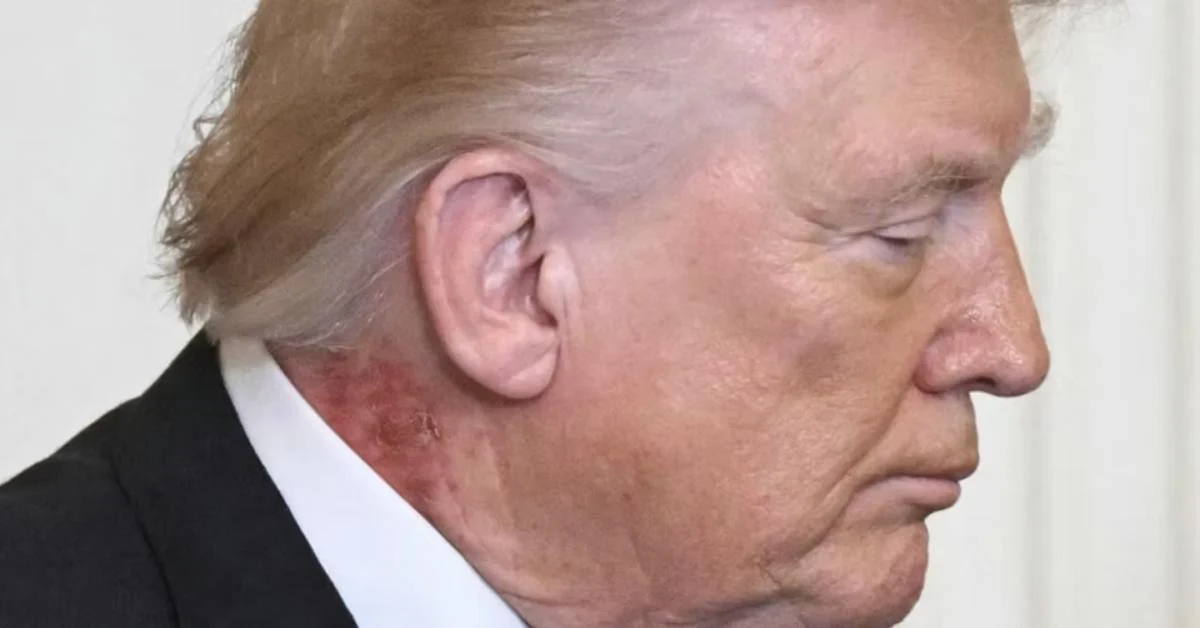 Mancha vermelha no pescoço de Trump reacende dúvidas sobre saúde; médico fala em erupção cutânea