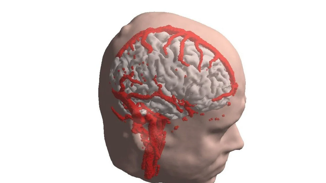 AVC: o papel decisivo do hemisfério oposto na recuperação motora