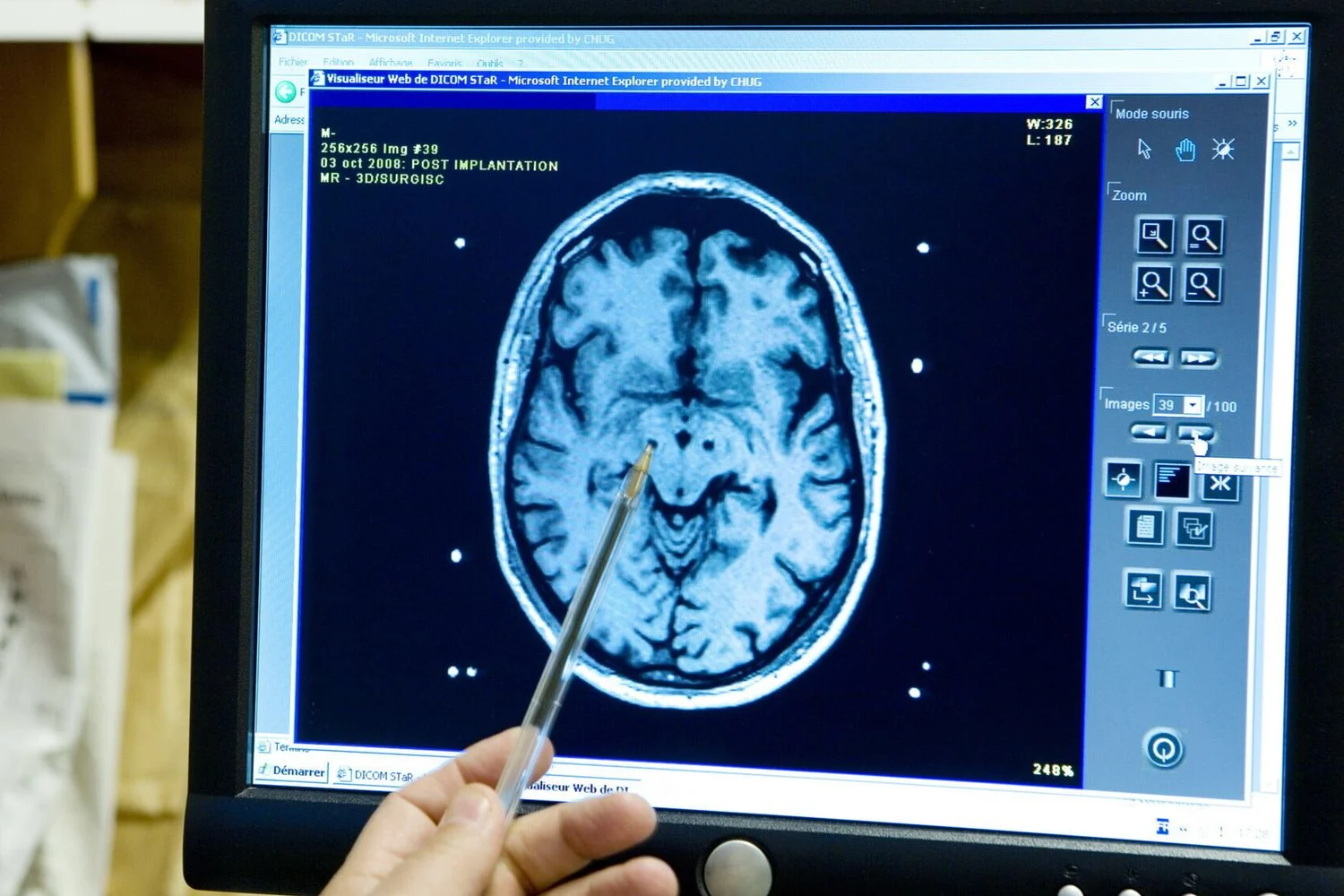 Cientistas reprogramam células de suporte em neurônios que mantêm o cérebro calmo