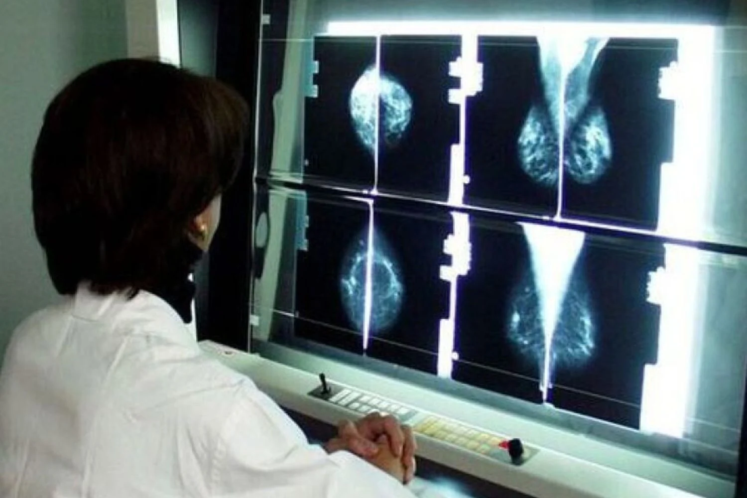 Assinaturas no DNA indicam risco de câncer de mama anos antes do tumor em portadoras de BRCA