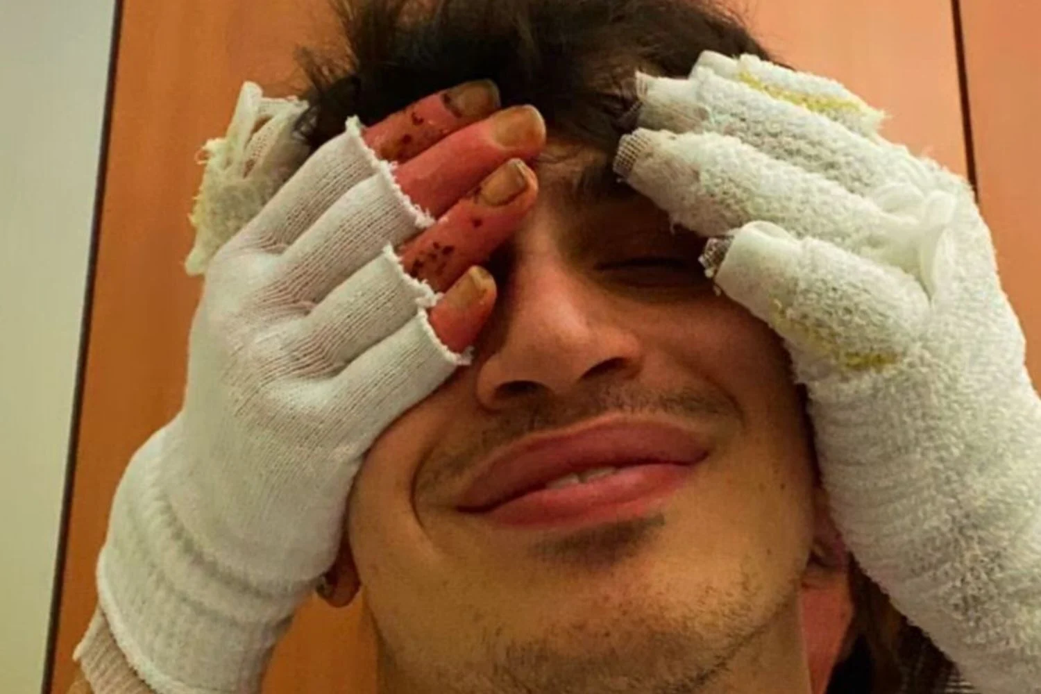 Eleonora Palmieri mostra cicatrizes após incêndio de Réveillon em Crans-Montana