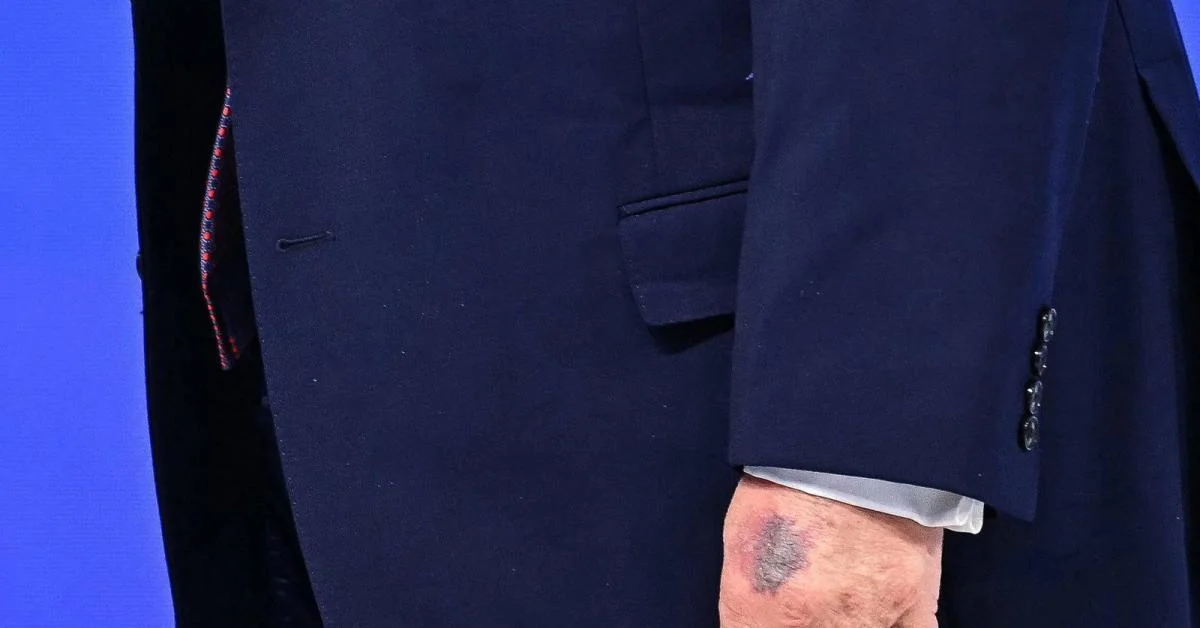 WEF Davos 2026: livido na mão esquerda de Donald Trump reacende questões sobre sua saúde; Casa Branca minimiza